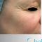 Fotorejuvenizácia /Resurfacing