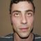 Ear surgery (Otoplasty)