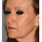 Facelift