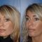 Dermal fillers