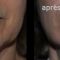Injections d