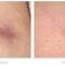 Laser Scar Treatment
