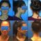 Otoplastie (Chirurgie esthétique des oreilles)