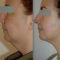 Chirurgie du double-menton