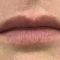 Teosyal, Restylane, Esthelis, Juverdem, Surgiderm (preparáty kyseliny hyaluronovej)