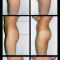 Augmentation et modelage des fesses et des hanches
