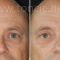 Eyelid surgery (Blepharoplasty)