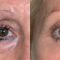 Blépharoplastie