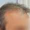 Haartransplantation