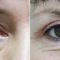 Operácia očných viečok (Blepharoplastika)