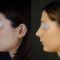 Rhinoplastie