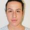Rhinoplasty (Nose Job)