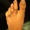 Hallux valgus -Operation