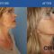 Lifting facial