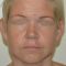 Facelift, SMAS facelifting