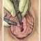 Hymenoplastie