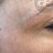 Age Spots Treatment