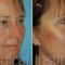 Liquid facelift