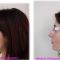 Rhinoplastie médicale