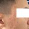 Acne laser, Cicatrici da acne laser
