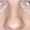 Operácia nosa (Rhinoplastika)