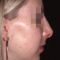 Rhinoplasty (Nose Job)