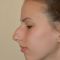 Rhinoplasty (Nose Job)