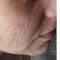 Glycolic peel