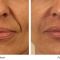 Facelift Silhouette Soft