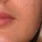 Lippenvergrößerung