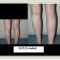 Chirurgie des fesses et des mollets