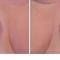 Hymenoplastie