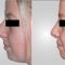 Rhinoplasty (Nose Job)