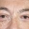 Blépharoplastie inférieure
