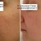Peeling chimique