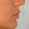 Hyaluronic acid-based wrinkle fillers