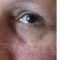 Hyaluronic acid-based wrinkle fillers