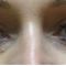 Operace očních víček (Blefaroplastika)