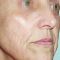 Traitements laser - dermatologie esthétique