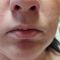 Teosyal, Restylane, Esthelis, Juverdem, Surgiderm (preparáty kyseliny hyaluronovej)