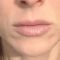 Nichtchirurgische Faltenbehandlung - BOTOX® / DYSPORT®