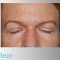 Operácia očných viečok (Blepharoplastika)