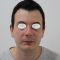 Rhinoplastie