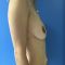 Augmentation mammaire (Implants mammaires)