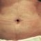 Liposukcja laserowa SlimLipo