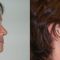 Facelift