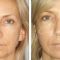 Antiaging