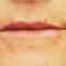 Hyaluronic acid-based wrinkle fillers