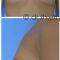 Lipofilling mammaire