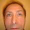 Blépharoplastie inférieure
